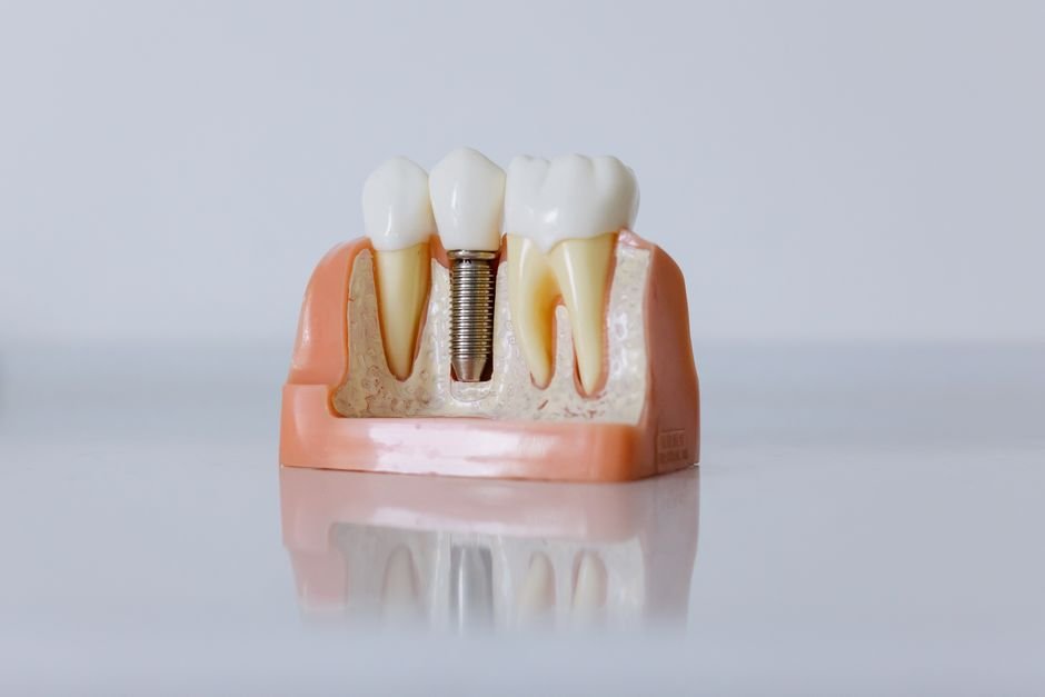 Common Questions About Dental Implant Safety